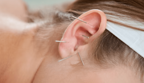 Acupuntura